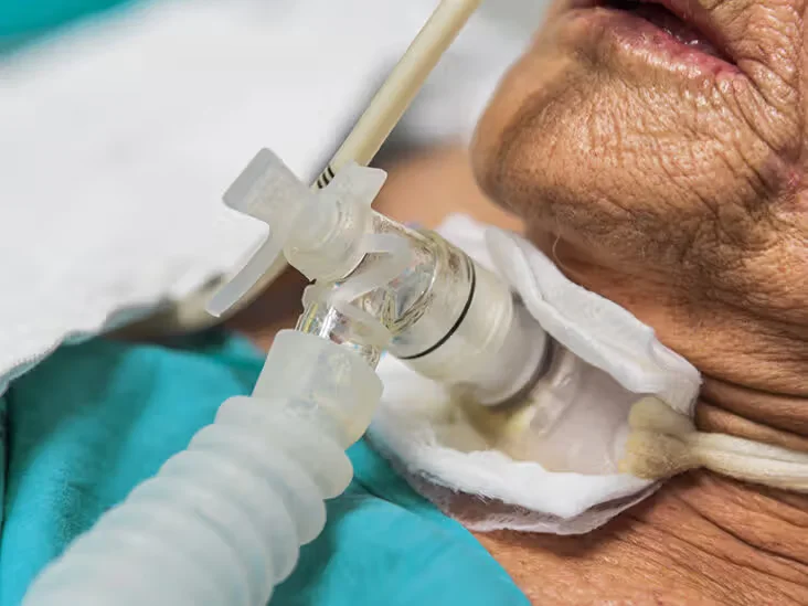 Tracheostomy Tube Change at Home